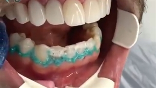 انجام پرسلن لامینیت ونیر و بلیچینگ