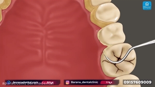 مراحل جرم گیری دندان به چه صورت است؟