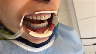 کامپوزیت ونیر ده دندان بالا با روشن ترین رنگ و انجام بلیچینگ دندان های فک پایین جهت تطابق رنگ