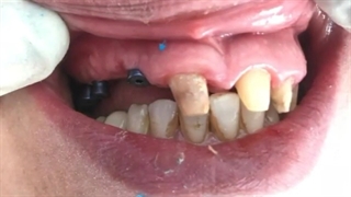 ایمپلنت دندان