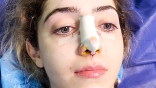 ده دقیقه بعد از عمل زیبایی بینی( بیمار از لندن اومده )