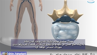 تنگی کانال نخاعی و درمان جراحی باز | دکتر طاهریان