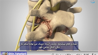 علائم و درمان تنگی کانال نخاعی | دکتر طاهریان