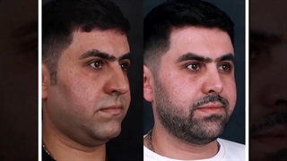 جراحی رینوپلاستی کاملا مردانه و متناسب با چهره فرد