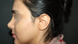 نمونه ای از جراحی رینوپلاستی کاملا طبیعی و متناسب با چهره فرد توسط دکتر داریوش نادری