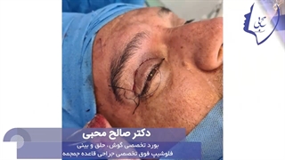 جراحی استیوم وسیع سینوس پیشانی و موکوسل