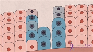 یکی از سرطان های زنان