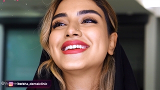 نتیجه ی بلیچینگ دندان در کلینیک بارانا