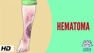 هماتوم، علل،  نشانه ها، تشخیص و درمان.