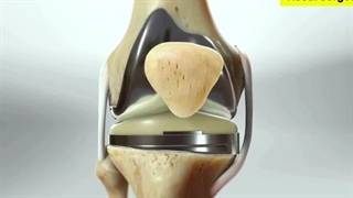 انیمیشن تعویض مفصل زانو