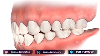 درمان کراس‌بایت با بریس ارتودنسی