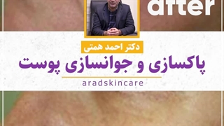 پاکسازی و جوانسازی پوست پیلینگ شیمیایی