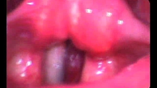 بهترین فوق تخصص حنجره و جراح حنجره در تهران، دکتر زهرا سرافراز