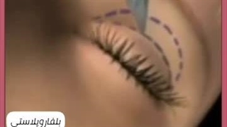 بلفاروپلاستی آمل