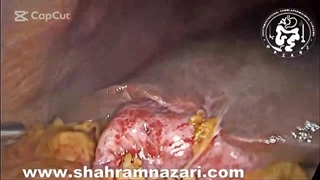 Importance of Critical View of Safety in Laparoscopic Cholecystectomy, an Accessory Right Hepatic Artery (aRHA)