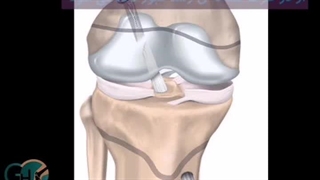بازسازی رباط صلیبی در کودکان