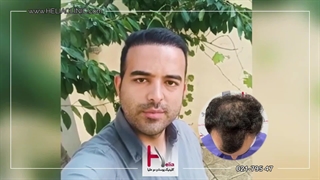 تراکم موی ایده آل پس از 5 ماه در کلینیک هلیا: شاهد نتایج حیرت‌انگیز باشید!