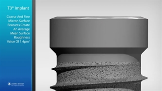 همه چیز درباره ایمپلنت زیمر