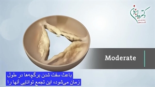 تنگی دریچه آئورت