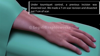 فیلم عمل جراحی کین باخ به روش کارپکتومی