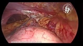 عمل لاپاراسکوپی معده کاملاً داخل قفسه سینه با گاستروپلاستی کالیس–نیسن برای مری کوتاه