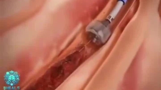 جراحی از بین بردن لخته‌های خون – روش‌ها و مراحل درمان