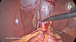 استنت‌گذاری در مجرای صفراوی مشترک بعد از بررسی لاپاراسکوپی کلدوک در سنگ مجرا صفرا