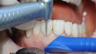 آیا امکان برداشتن لمینت و بازگشت به دندان‌های طبیعی وجود دارد؟