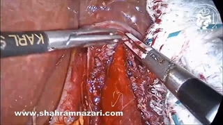 سوراخ شدن مخاط در عمل آشالازی: ترمیم سوراخ شدگی مری تشخیص داده شده در حین عمل