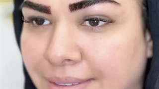 کاشت ابروی سوپر نچرال در کلینیک زیبایی رنسانس