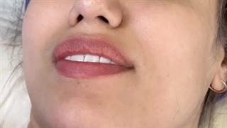 کاشت ابروی طبیعی بدون جراحی در کلینیک زیبایی رنسانس