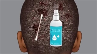 *Hamonium Asmr 2024*اصلاح موی سر و درمان شپش و شوره و جوش پشت گردن-قسمت هفدهم کربوکسی تراپی