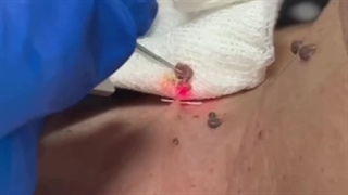 از بین بردن ضایعات پوستی در کلینیک گونه